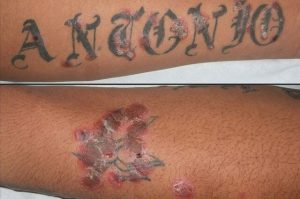 Czy można bezpiecznie wykonać tatuaż przy łuszczycy?