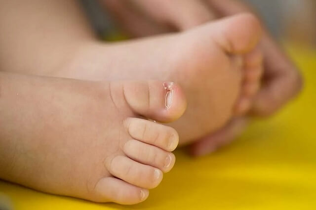 Co zrobić gdy dziecku wrasta paznokieć?